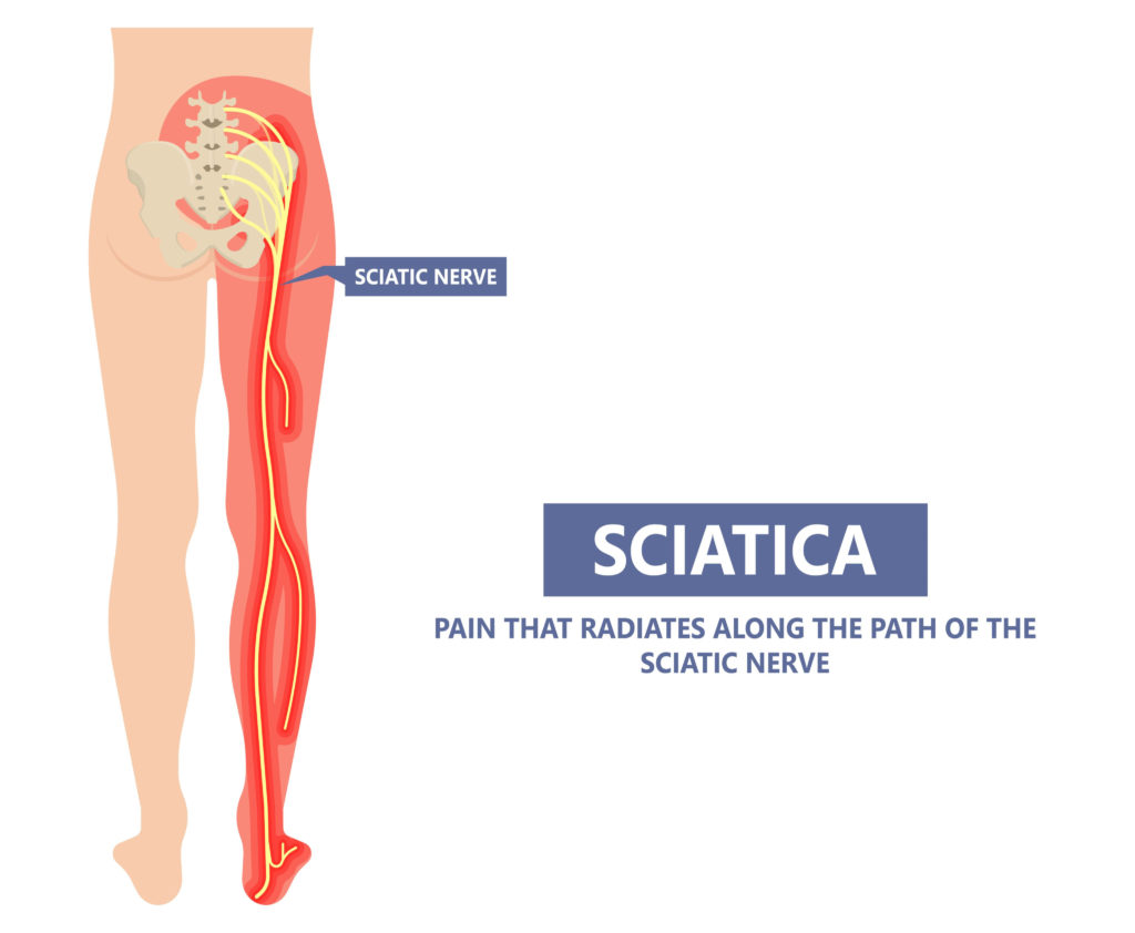 How to Releive Sciatic Nerve Pain